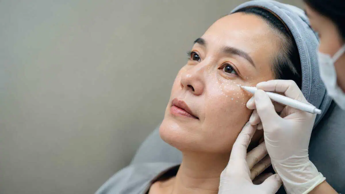PRFM under-eye treatment for fine lines and skin rejuvenation