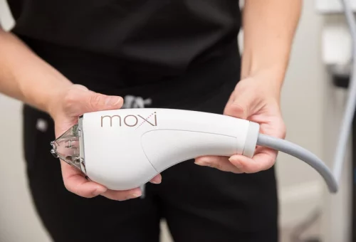 Moxi Laser Treatment in Murrysville, PA | Smooch Aesthetics